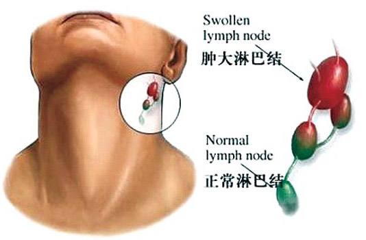 因甲醛超標(biāo)而引起的淋巴癌怎么辦？